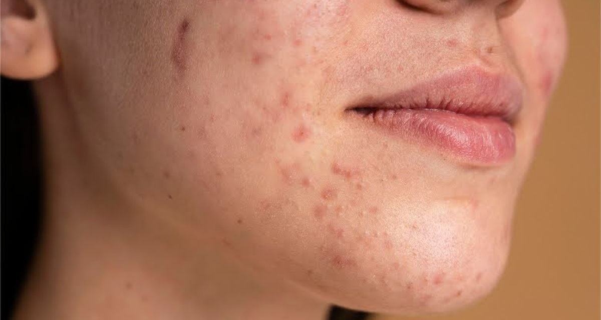 Jangan Asal Pakai! Ini Bahaya Pasta Gigi untuk Jerawat yang Jarang Diketahui